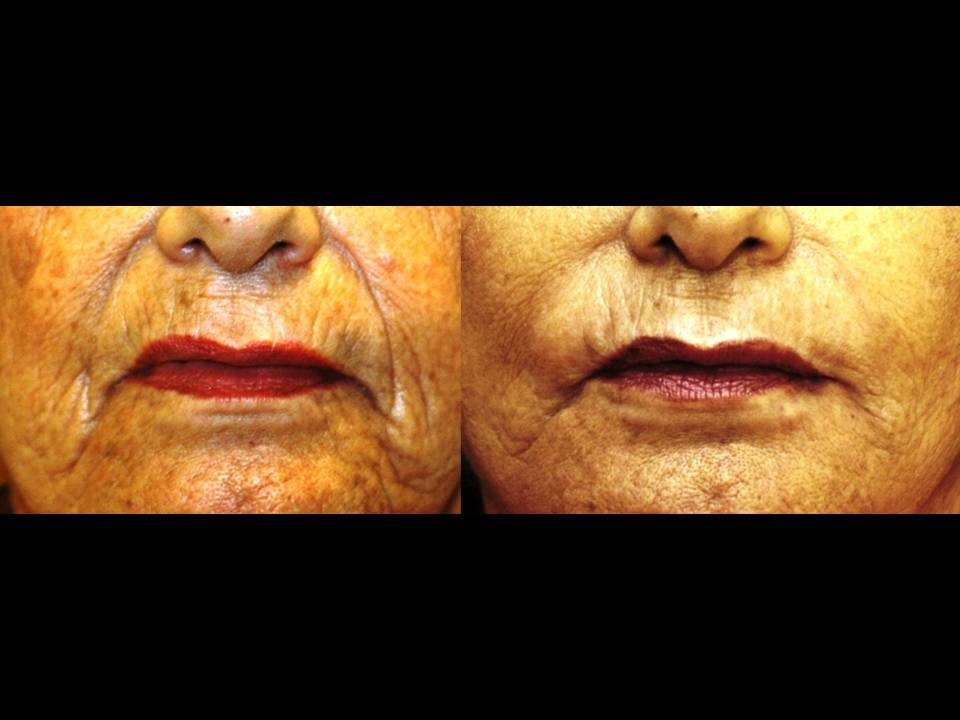 Sculptra Surgery