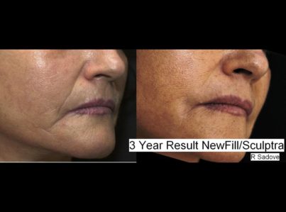 Sculptra Surgery