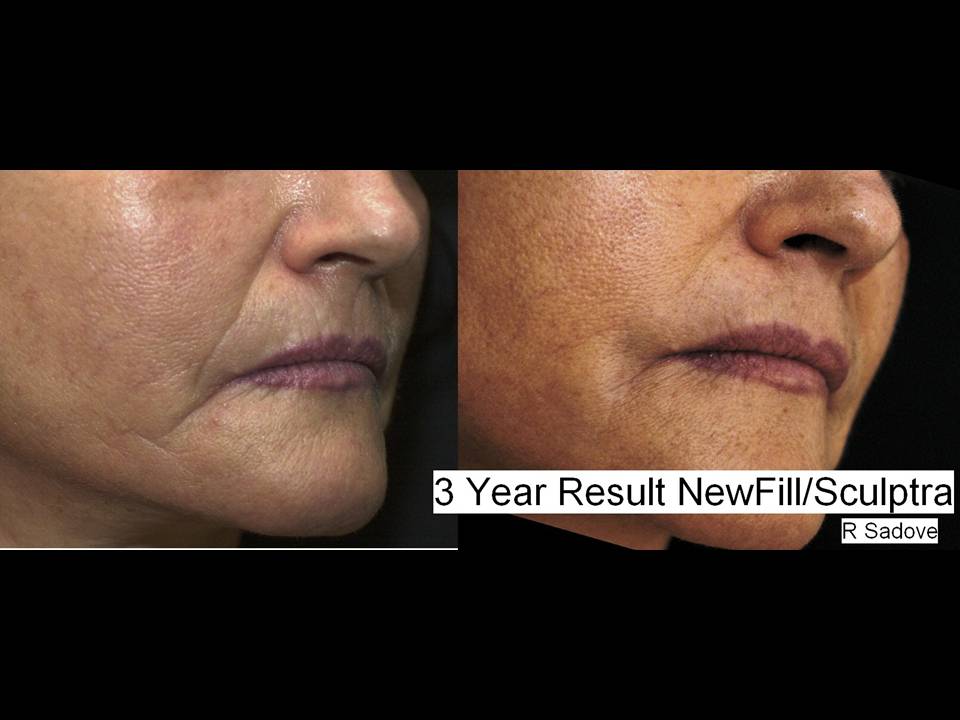 Sculptra Surgery