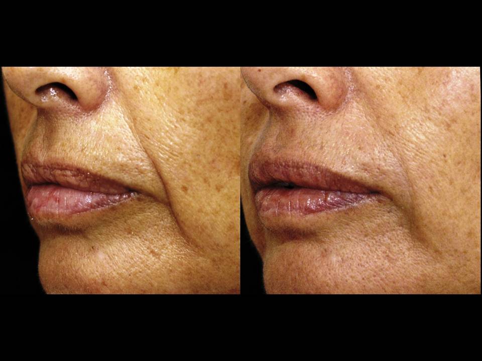 Sculptra Surgery