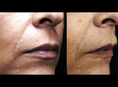 Sculptra Surgery