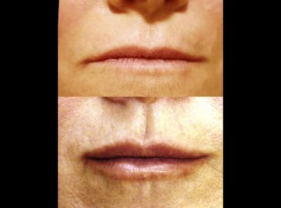 Sculptra22