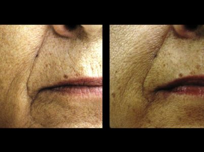 Sculptra26