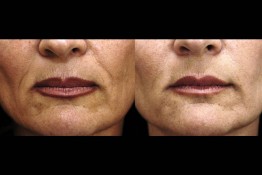 Sculptra Surgery