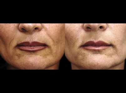 Sculptra Surgery