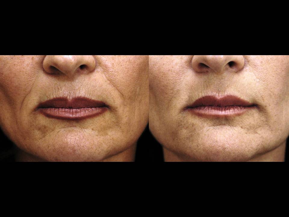 Sculptra Surgery