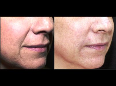 Sculptra38