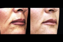 Sculptra Surgery