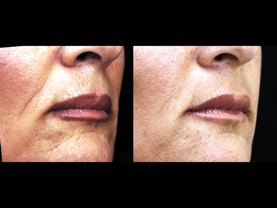 Sculptra Surgery