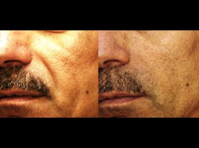Sculptra52