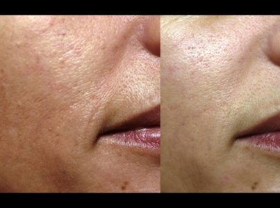 Sculptra Surgery