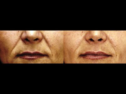 Sculptra Surgery