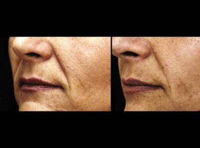 Sculptra Surgery