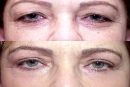 Upper Eyelid Surgery