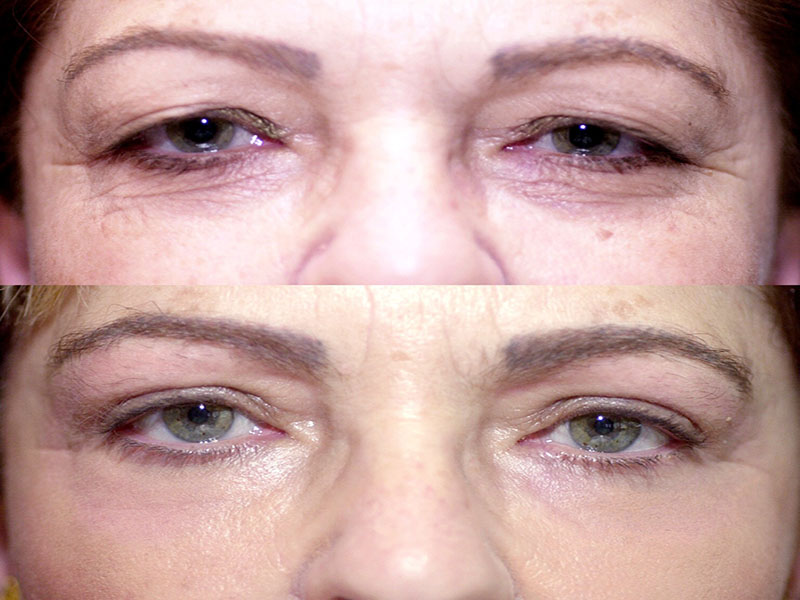 Upper Eyelid Surgery