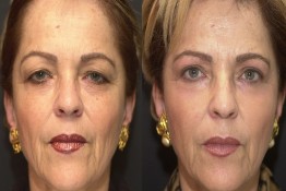 Upper Eyelid Surgery