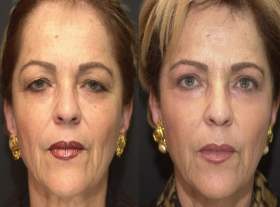 Upper Eyelid Surgery