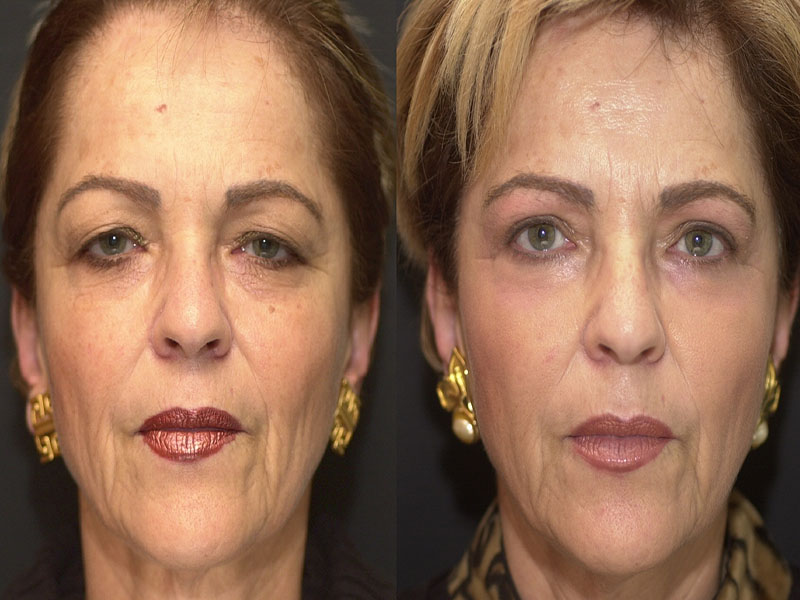 Upper Eyelid Surgery