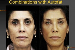Auto-Fat Injection Surgery