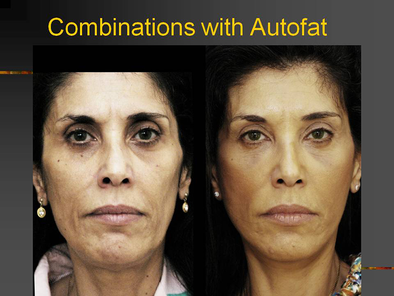 Auto-Fat Injection Surgery