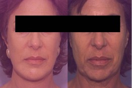 Chin Implant and Reduction Surgery