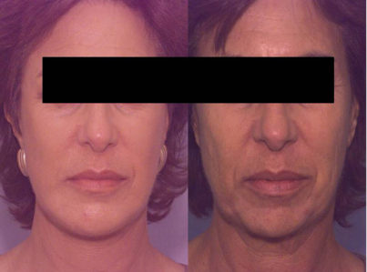 Chin Implant and Reduction Surgery