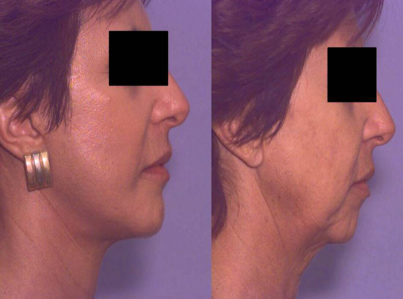 Chin Implant and Reduction Surgery