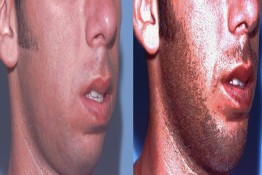 Chin Implant and Reduction Surgery