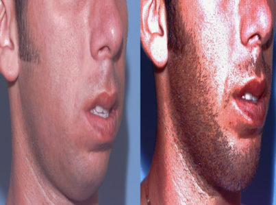 Chin Implant and Reduction Surgery