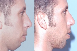 Chin Implant and Reduction Surgery