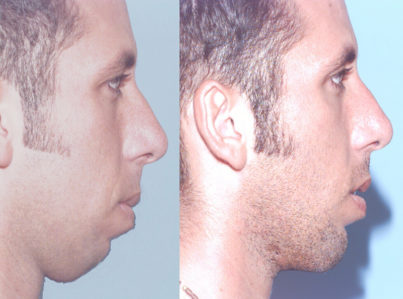 Chin Implant and Reduction Surgery