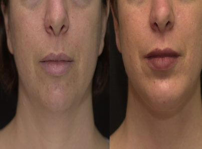 Chin Implant and Reduction Surgery