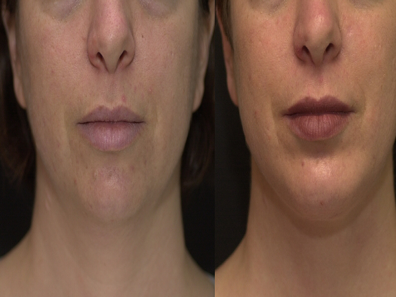 Chin Implant and Reduction Surgery