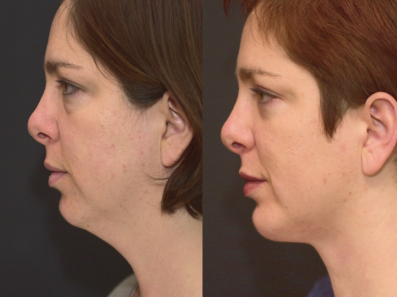 Chin Implant and Reduction Surgery