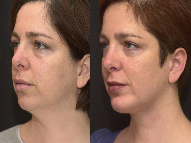 Chin Implant and Reduction Surgery