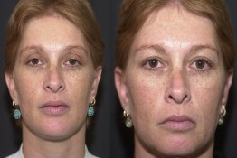 Chin Implant and Reduction Surgery