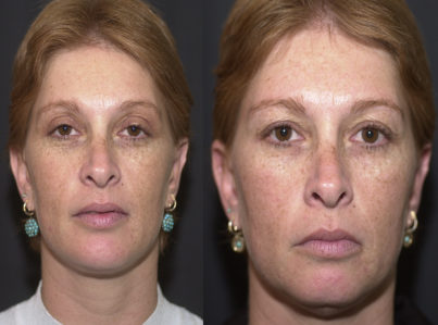 Chin Implant and Reduction Surgery