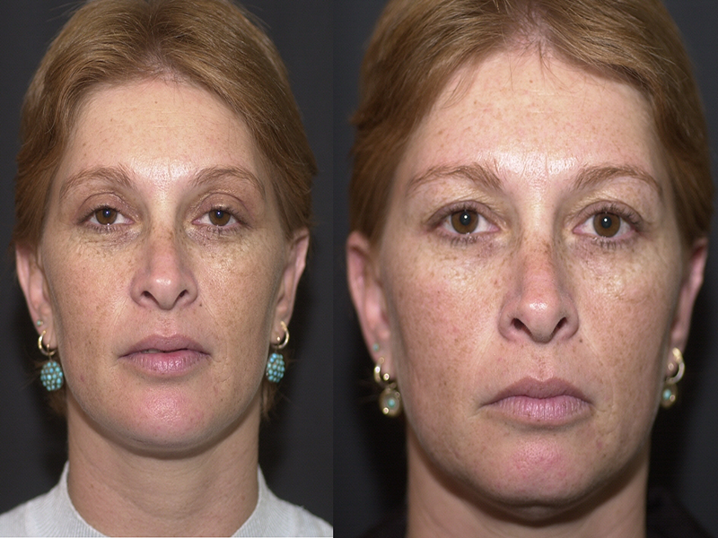 Chin Implant and Reduction Surgery