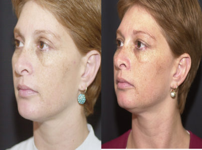 Chin Implant and Reduction Surgery