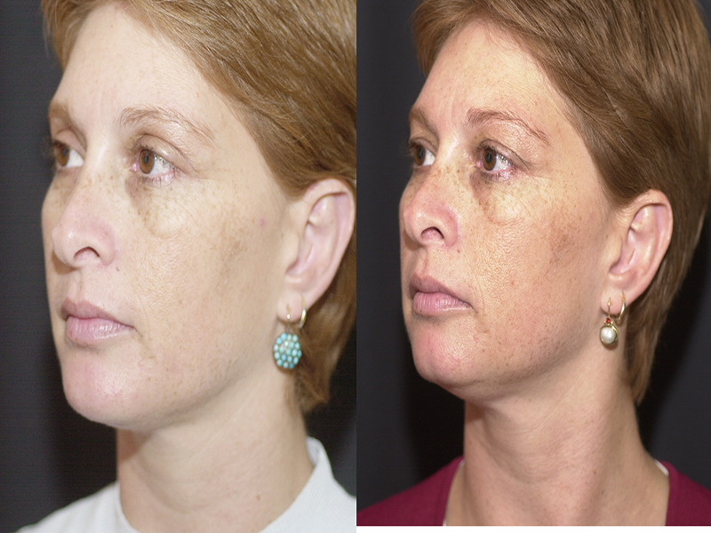 Chin Implant and Reduction Surgery