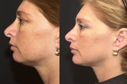 Chin Implant and Reduction Surgery