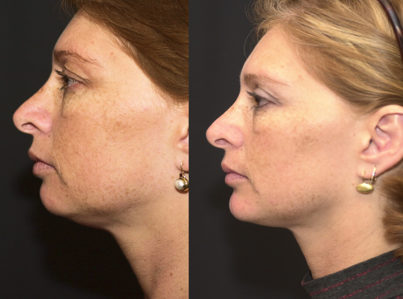 Chin Implant and Reduction Surgery