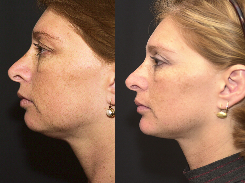 Chin Implant and Reduction Surgery