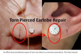Ear Lobe Repair Surgery