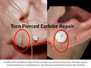 Ear Lobe Repair Surgery