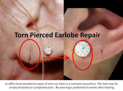 Ear Lobe Repair Surgery