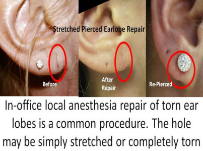 Ear Lobe Repair Surgery