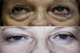 Lower Eyelid Surgery