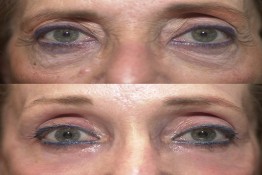 Lower Eyelid Surgery