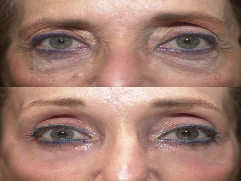 Lower Eyelid Surgery